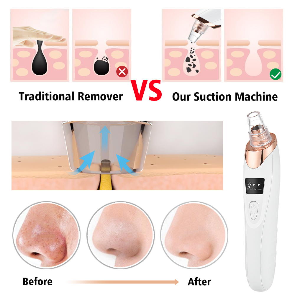 Mụn Đầu Đen Vacosi Pore Cleane - đánh giá và giá Pore Vacuum